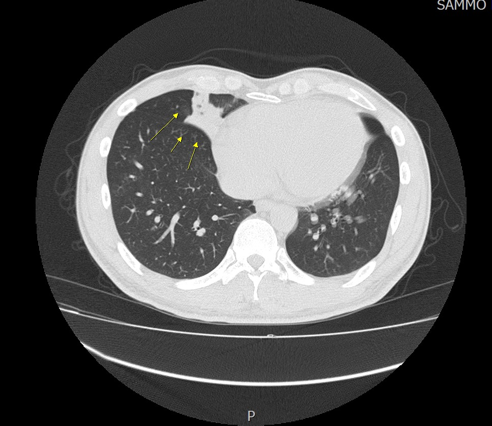 삼모라인내과의원 폐렴 진단사례 검사 영상 1